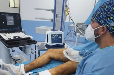 Laser varices