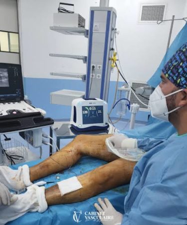 Laser varices